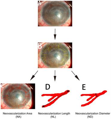 Successful regression of newly formed corneal neovascularization by subconjunctival injection of bevacizumab in patients with chemical burns